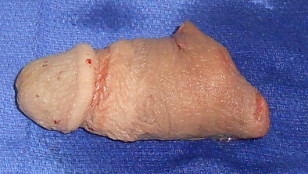 前交叉韧带修复手术前后的情况记录